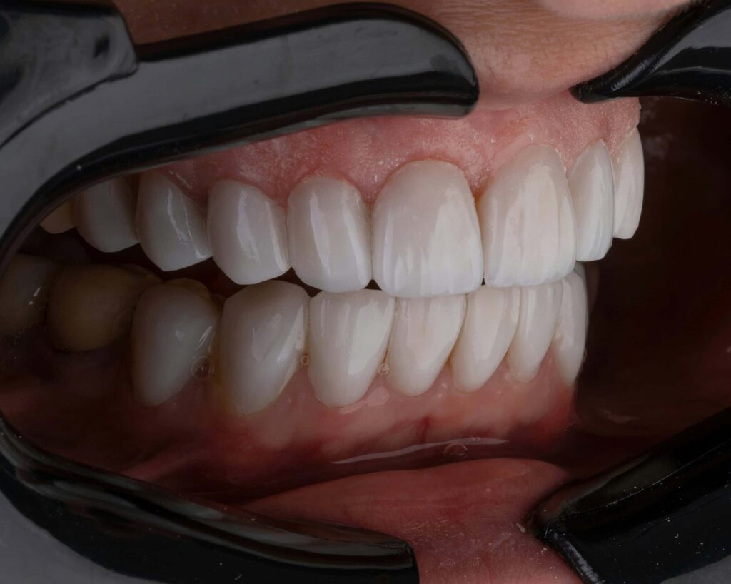 bioengineered-dental-implants-a-revolutionary-leap-in-oral-health