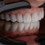 bioengineered-dental-implants-a-revolutionary-leap-in-oral-health
