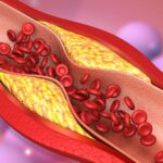 discover-the-superfood-that-unclogs-arteries-better-than-aspirin