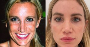 lisa-s-decade-long-battle-against-sun-damage-a-journey-to-radiant-skin
